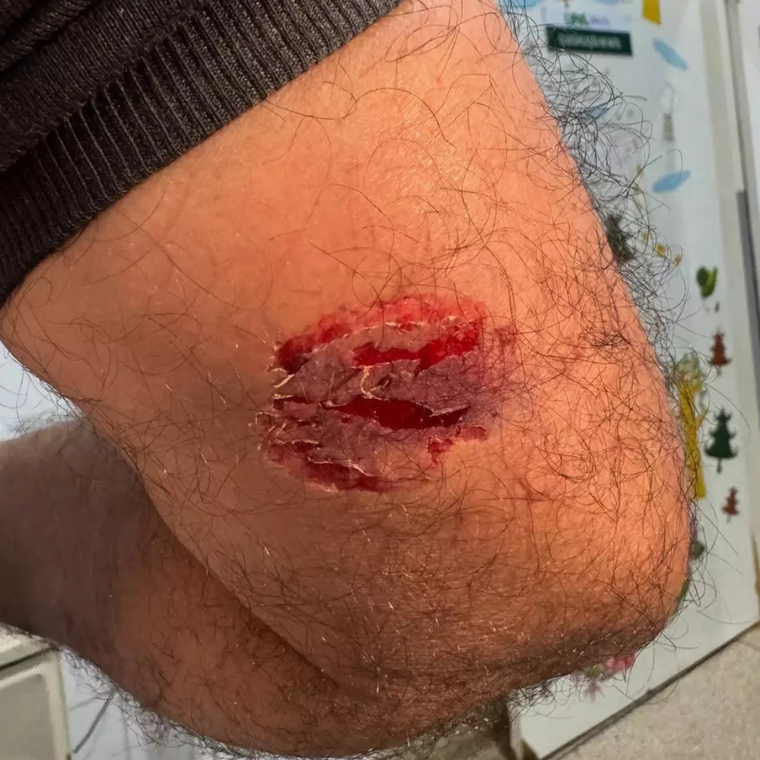 Profissional da saúde é mordido por paciente em surto durante atendimento em UPA de Dourados